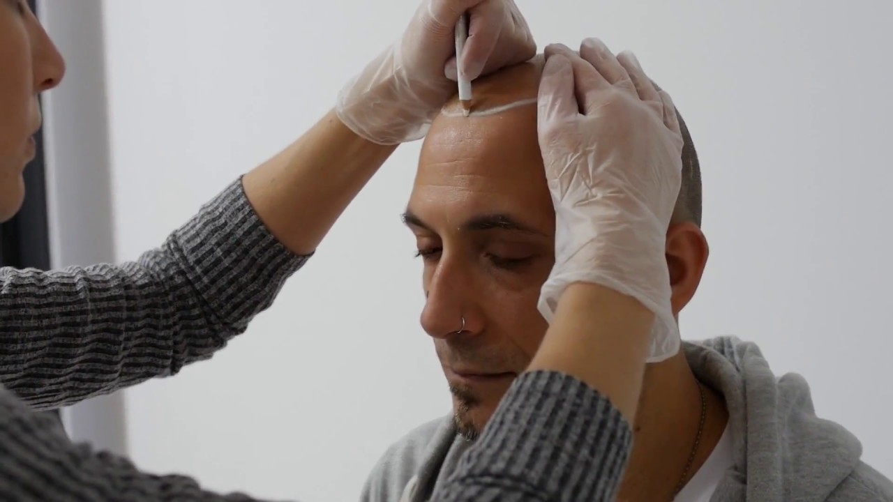 Scalp Micropigmentation UK