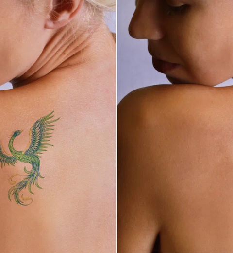 Tattoo Removal