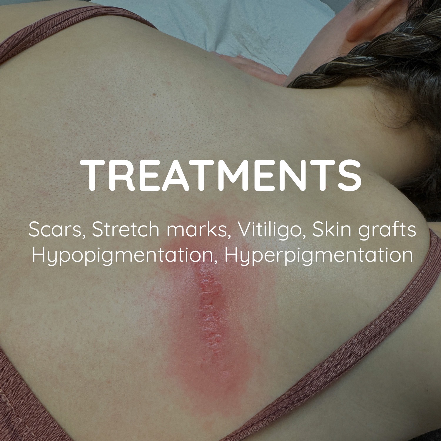 ink illusions treatments banner scars stretch marks