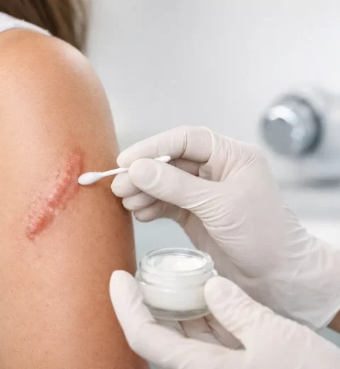 How to Treat Hypertrophic Scars Safely